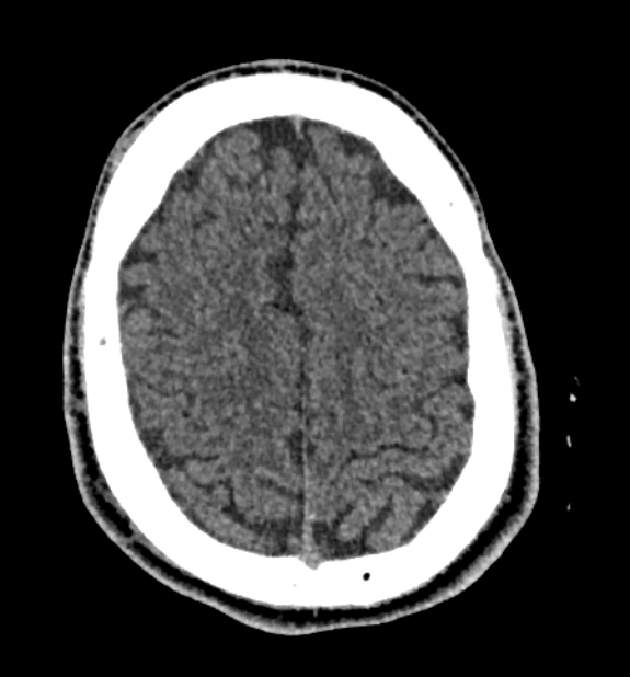 Acute ischemic stroke - posterior circulation territory (Radiopaedia 77670-89881 non-contrast 73).jpg