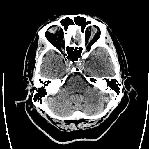 Acute left middle cerebral artery territory ischemic stroke (Radiopaedia 35688-37223 Axial non-contrast 17).png
