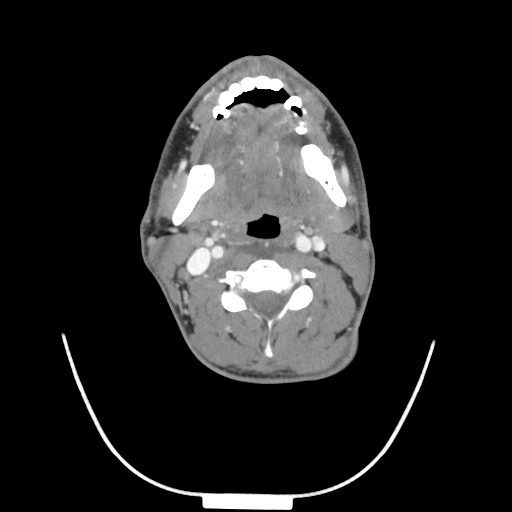 Acute longus colli calcific tendinitis (Radiopaedia 72495-83036 Axial C+ arterial phase 40).jpg