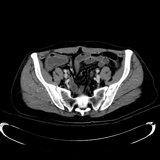 Acute myocardial infarction in CT (Radiopaedia 39947-42415 Axial C+ portal venous phase 101).jpg