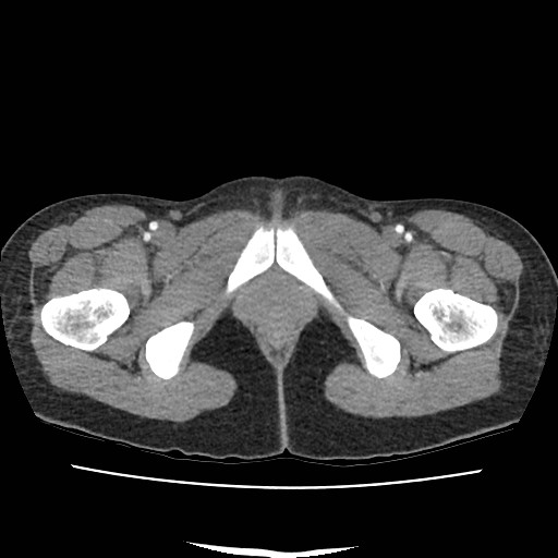 File:Acute myocarditis (Radiopaedia 55988-62613 Axial C+ portal venous phase 85).jpg