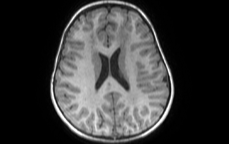 File:Acute necrotizing encephalitis of childhood (Radiopaedia 67356-76737 Axial T1 34).jpg