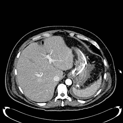 Acute pancreatic necrosis (Radiopaedia 13560-18500 Axial C+ portal venous phase 33).jpg