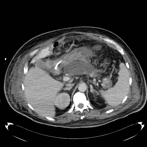 File:Acute pancreatic necrosis (Radiopaedia 13560-18503 Axial C+ portal venous phase 22).jpg
