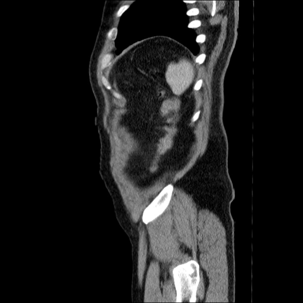 Acute pancreatitis (Radiopaedia 26663-26813 Sagittal C+ portal venous phase 67).jpg