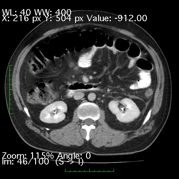 File:Acute pancreatitis (Radiopaedia 34043-35276 Axial C+ portal venous phase 46).jpg