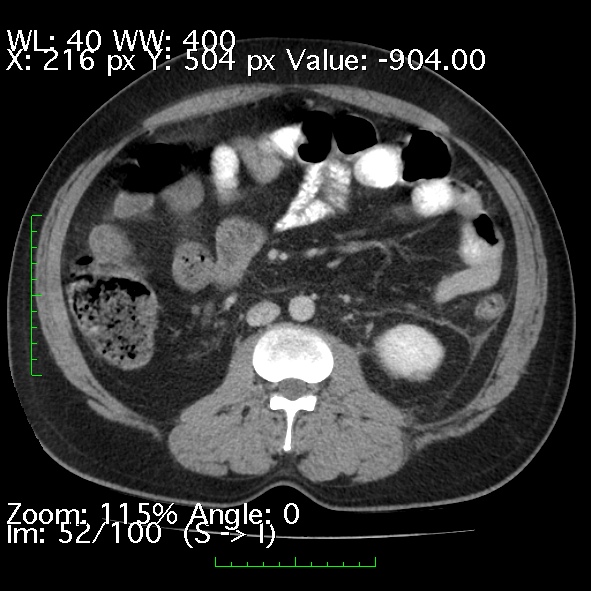 Acute pancreatitis (Radiopaedia 34043-35276 Axial C+ portal venous phase 52).jpg