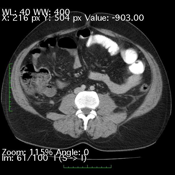 File:Acute pancreatitis (Radiopaedia 34043-35276 Axial C+ portal venous phase 61).jpg