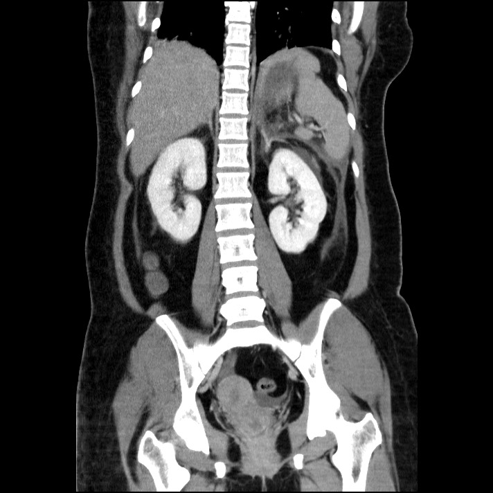 Acute pancreatitis (Radiopaedia 69236-79012 Coronal C+ portal venous phase 31).jpg