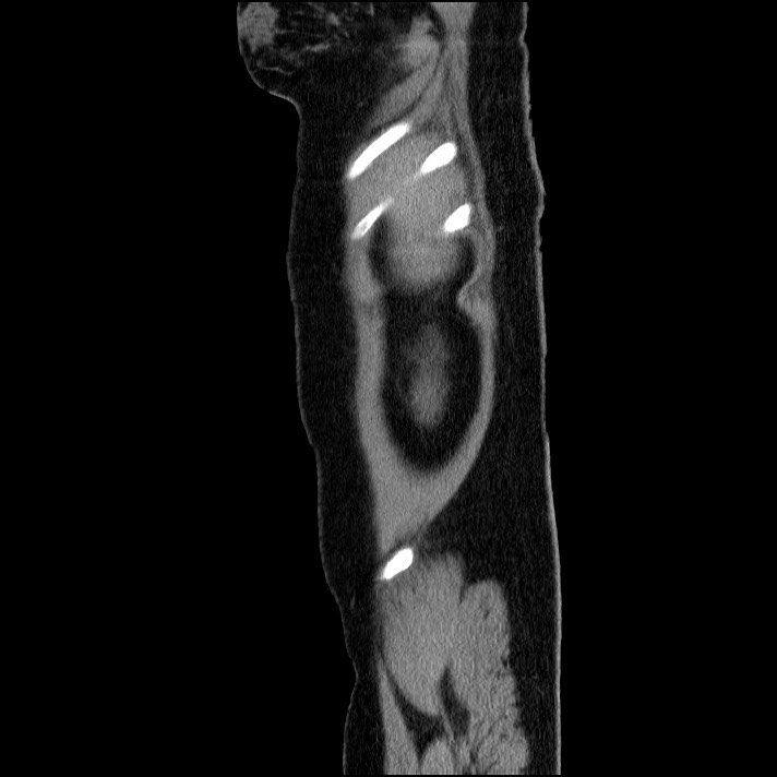 Acute pancreatitis (Radiopaedia 69236-79012 Sagittal C+ portal venous phase 87).jpg