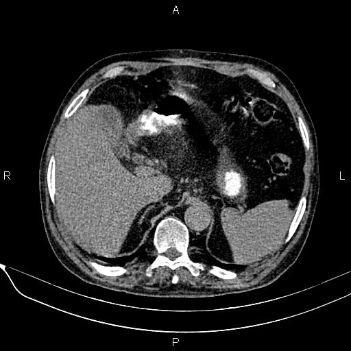 Acute pancreatitis (Radiopaedia 85146-100701 Axial non-contrast 33).jpg