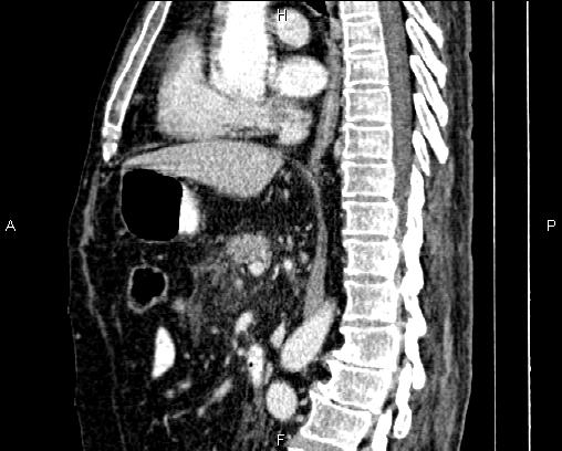 Acute pancreatitis (Radiopaedia 85146-100701 Sagittal C+ portal venous phase 48).jpg