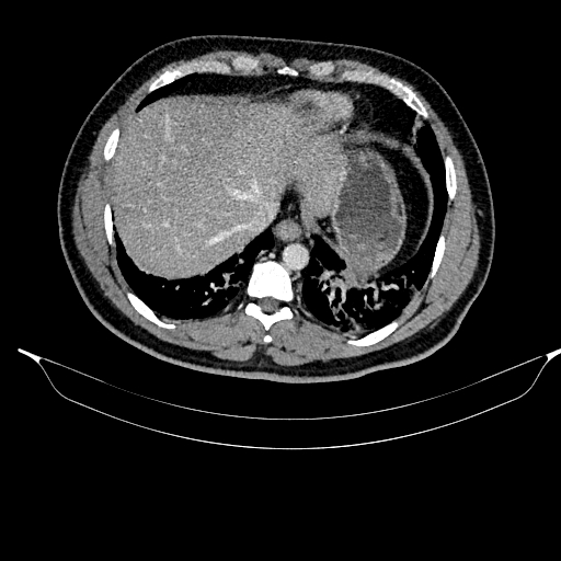 Acute pancreatitis (Radiopaedia 87428-103757 Axial C+ portal venous phase 19).jpg