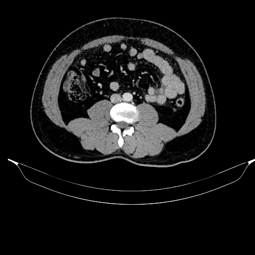 Acute pancreatitis (Radiopaedia 87428-103757 Axial C+ portal venous phase 59).jpg