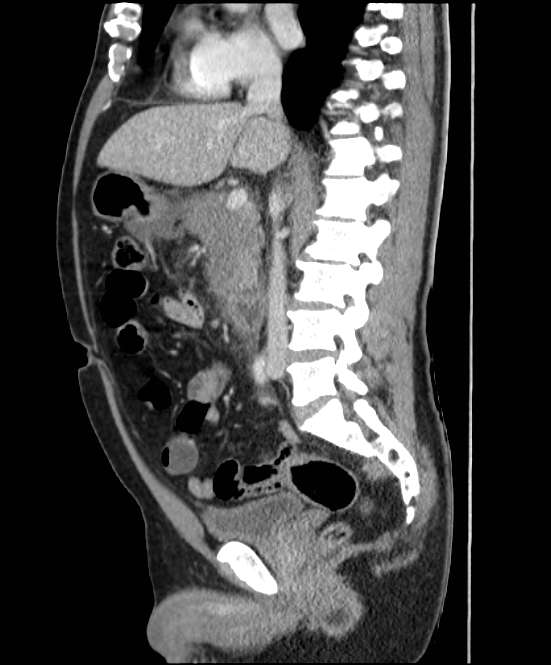 Acute pancreatitis - Balthazar E (Radiopaedia 23080-23110 Sagittal C+ portal venous phase 45).jpg