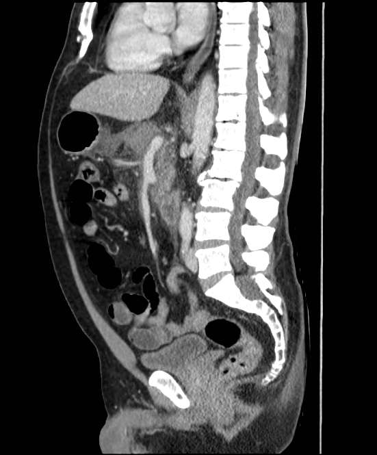 Acute pancreatitis - Balthazar E (Radiopaedia 23080-23110 Sagittal C+ portal venous phase 50).jpg