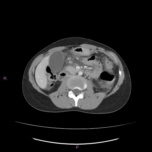 Acute pancreatitis secondary to stone at minor papilla and pancreatic divisum (Radiopaedia 76570-88333 Axial C+ portal venous phase 36).jpg