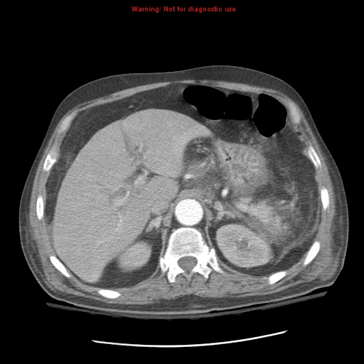 File:Acute pancreatitis with incidental pancreatic lipoma (Radiopaedia 10190-10730 Axial C+ arterial phase 29).jpg