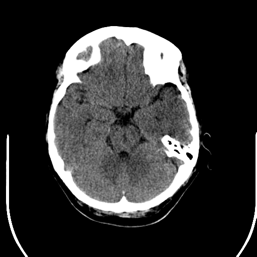 File:Acute pontine infarct from vertebral artery dissection (Radiopaedia 34111-35369 Axial non-contrast 9).png