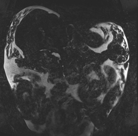 Acute portal vein thrombosis (Radiopaedia 73198-83925 Coronal Heavily T2 thin cuts 31).jpg