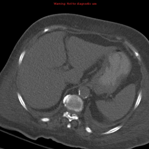File:Acute pulmonary embolism (Radiopaedia 13286-13289 Axial C+ CTPA 65).jpg