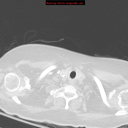 File:Acute pulmonary embolism (Radiopaedia 13286-13289 B 2).jpg