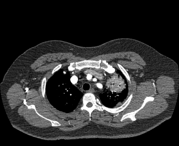 Acute pulmonary embolism with pulmonary infarcts (Radiopaedia 77688-89908 Axial C+ CTPA 9).jpg