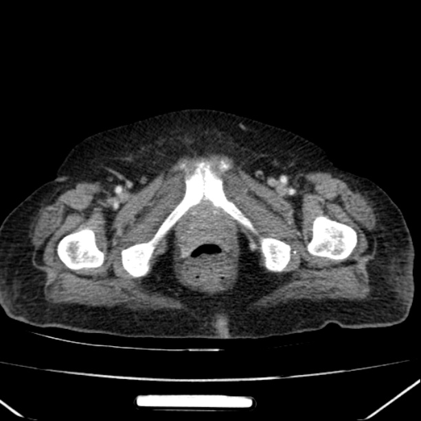 Acute pyelonephritis (Radiopaedia 26584-26729 Axial renal cortical phase 77).jpg