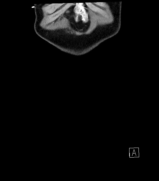 Acute renal infarction (Radiopaedia 59375-66736 Coronal C+ portal venous phase 3).jpg