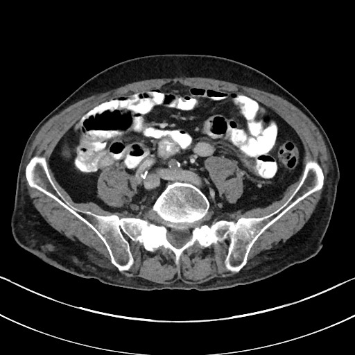 Acute renal infarction - rim capsular enhancement (Radiopaedia 59833-67270 Axial C+ portal venous phase 65).jpg