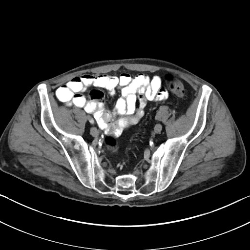 Acute renal infarction - rim capsular enhancement (Radiopaedia 59833-67270 Axial C+ portal venous phase 79).jpg