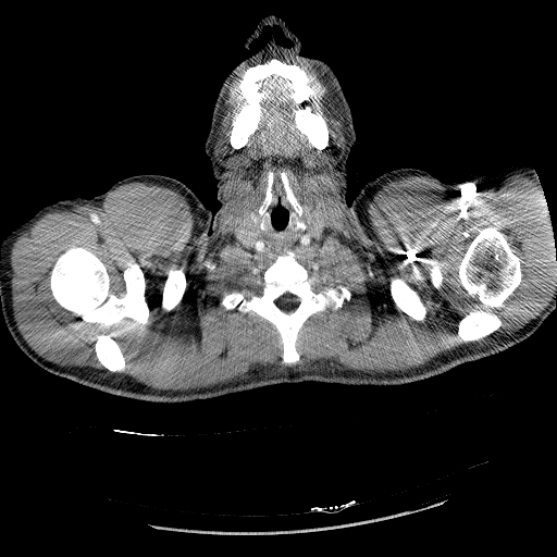 Acute segmental pulmonary emboli and pulmonary infarction (Radiopaedia 62264-70444 Axial C+ CTPA 3).jpg