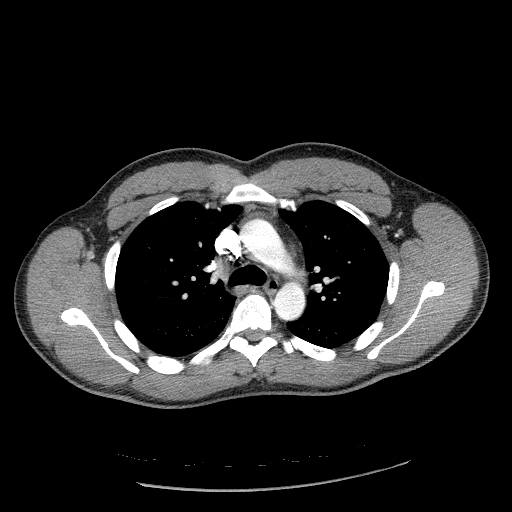 Acute segmental pulmonary emboli and pulmonary infarction (Radiopaedia 62264-70444 Axial C+ CTPA 41).jpg