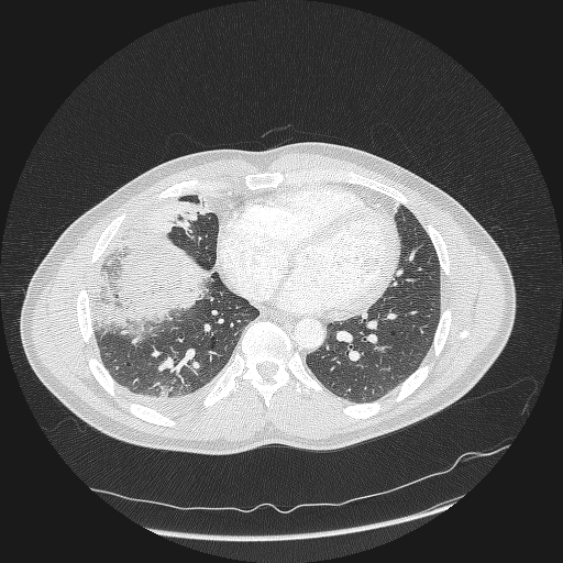 File:Acute segmental pulmonary emboli and pulmonary infarction (Radiopaedia 62264-70444 Axial lung window 127).jpg