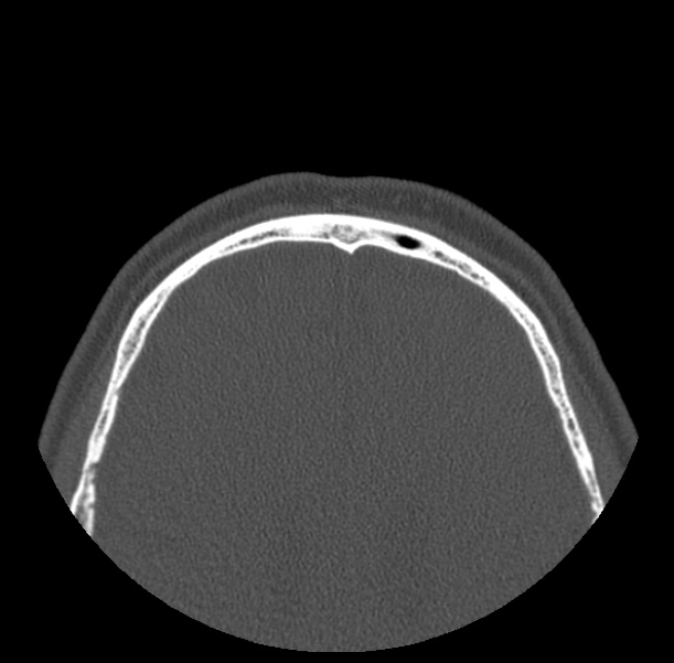 Acute sinusitis (Radiopaedia 23161-23215 Axial bone window 81).jpg