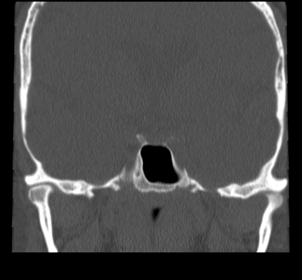 Acute sinusitis (Radiopaedia 23161-23215 Coronal bone window 55).jpg