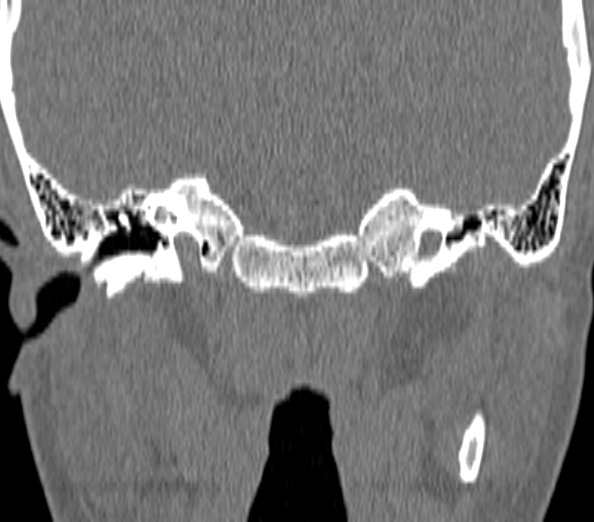 Acute sinusitis (Radiopaedia 40564-43158 Coronal bone window 55).jpg