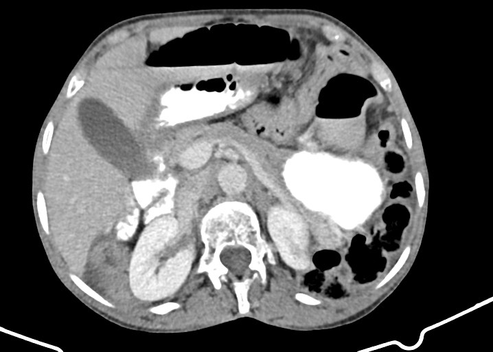 File:Acute small bowel (ileal) volvulus (Radiopaedia 71740-82139 Axial C+ portal venous phase 70).jpg