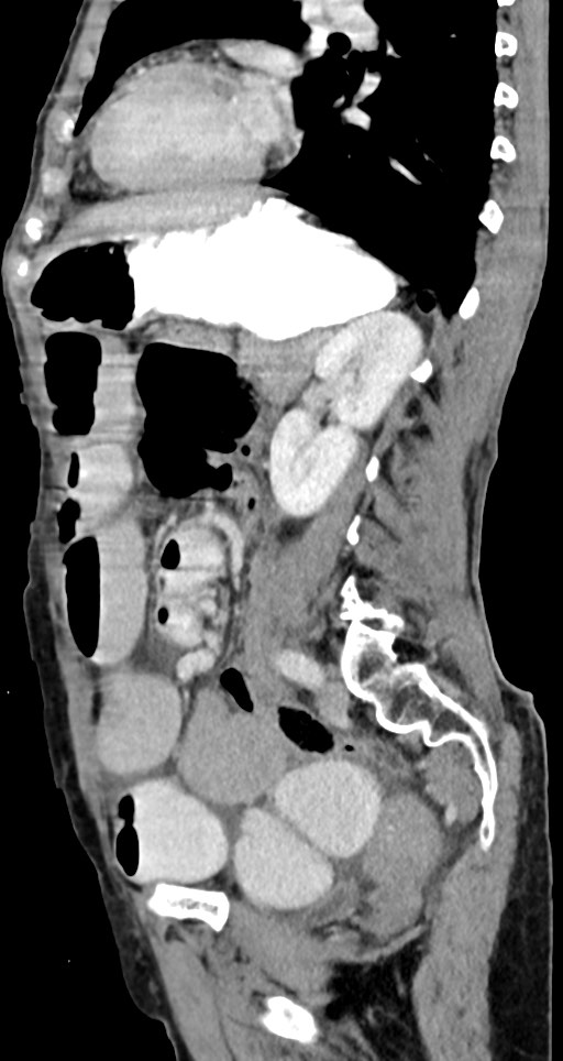Acute small bowel (ileal) volvulus (Radiopaedia 71740-82139 Sagittal C+ portal venous phase 69).jpg