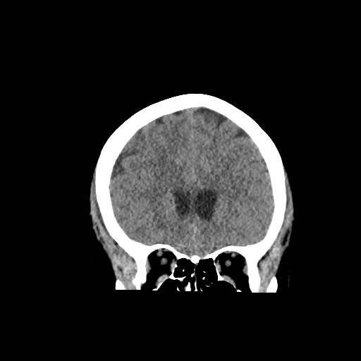 Acute subarachnoid hemorrhage and accessory anterior cerebral artery (Radiopaedia 69231-79008 Coronal non-contrast 24).jpg