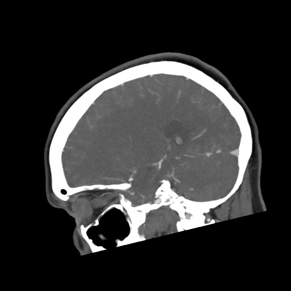 File:Acute subarachnoid hemorrhage and accessory anterior cerebral artery (Radiopaedia 69231-79009 Sagittal C+ arterial phase 47).jpg