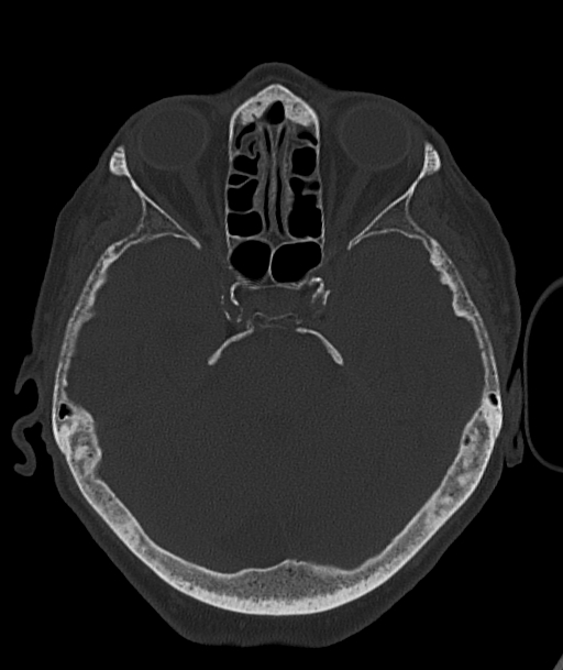 Acute traumatic subdural hematoma (Radiopaedia 82921-97257 Axial bone window 73).jpg