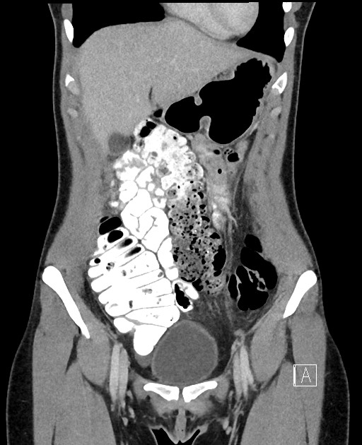 Acute uncomplicated appendicitis (Radiopaedia 61374-69304 Coronal C+ portal venous phase 26).jpg