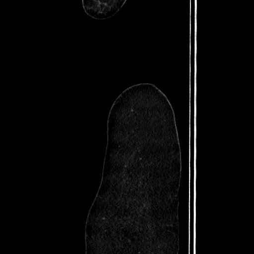 Acute uncomplicated appendicitis (Radiopaedia 73704-84499 Sagittal C+ portal venous phase 24).jpg