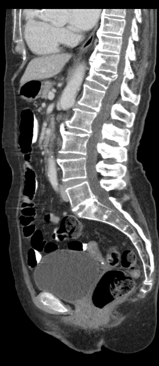 Adenocarcinoma of cecum (Radiopaedia 59222-66549 Sagittal C+ portal venous phase 45).jpg