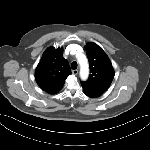 Adenocarcioma of rectum- T1 lesion (Radiopaedia 36921-38547 Axial C+ arterial phase 17).png