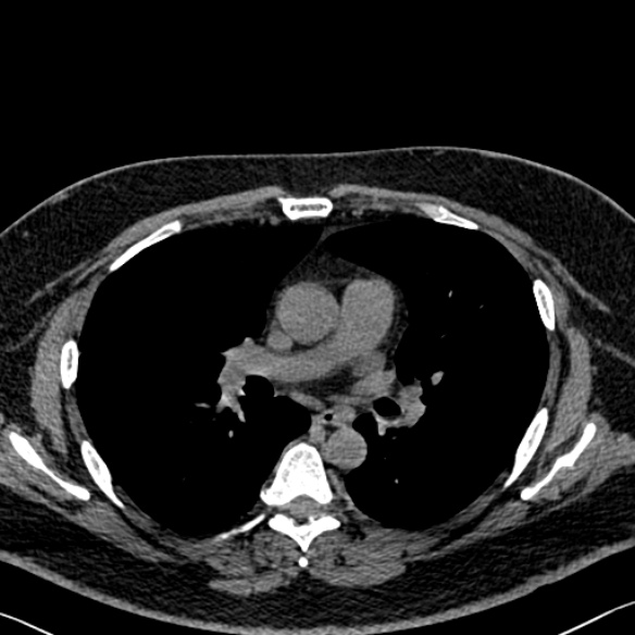 File:Adenoid cystic carcinoma of the trachea (Radiopaedia 49042-54137 Axial non-contrast 166).jpg