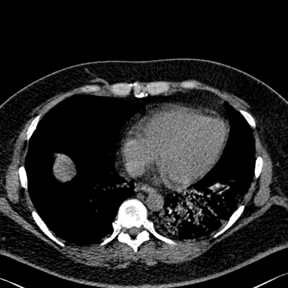 Adenoid cystic carcinoma of the trachea (Radiopaedia 49042-54137 Axial non-contrast 242).jpg