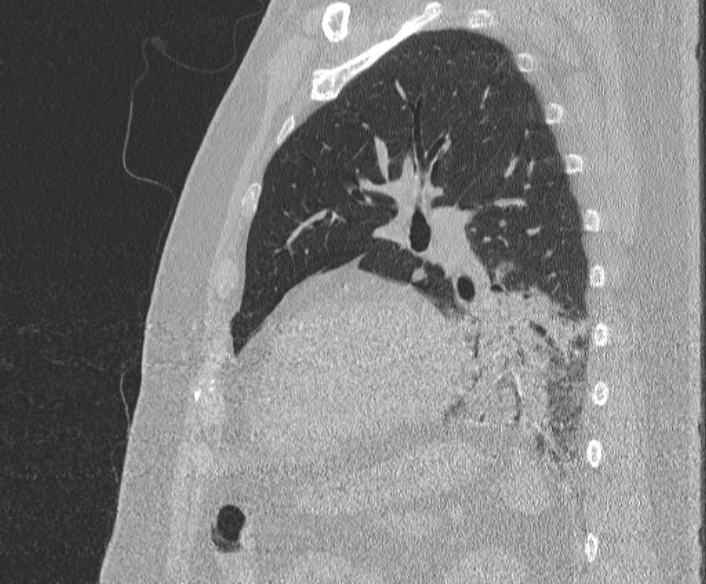 Adenoid cystic carcinoma of the trachea (Radiopaedia 49042-54137 Sagittal lung window 321).jpg