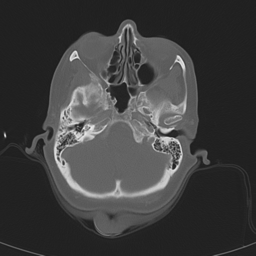 Adenoid cystic tumor of palate (Radiopaedia 46980-51518 Axial bone window 16).png